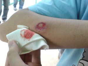 Paintball Injury First Aid