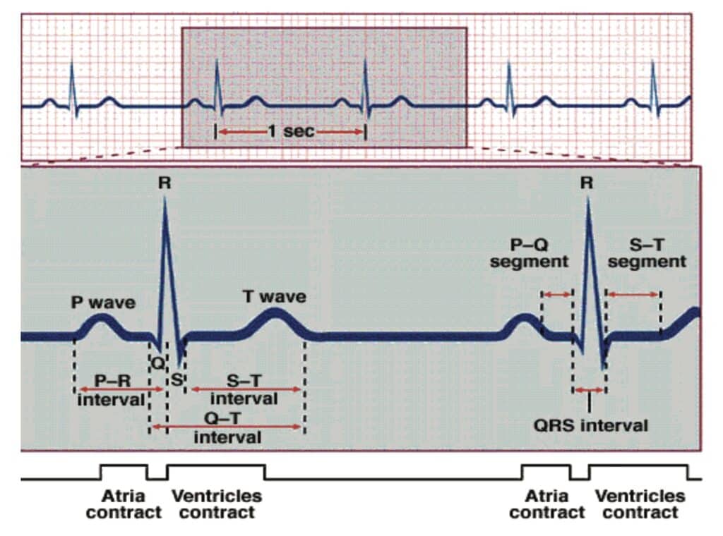 An image of Electrocardiogram Waves (P-QRS-T Waves).