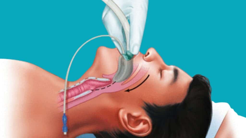 An illustration of a Laryngeal Mask Airway Insertion