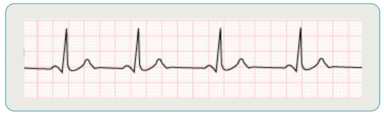 Decoding ECG: Understand VTach vs VFib Easily | SureFire CPR