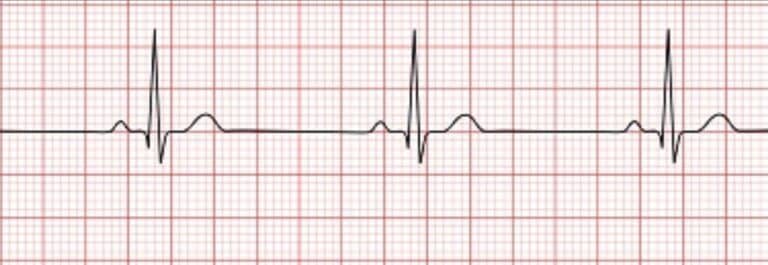 Life on the Line: PEA and EKG Triggers