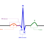 Reading an ECG