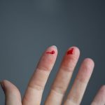 Blood loss from capillary bleeding from fingers